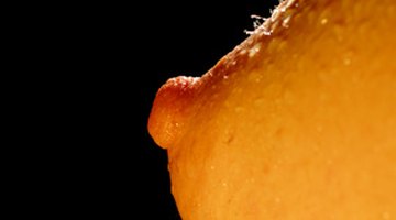 ¿Cuál es el tratamiento para el papiloma intraductal de los senos?