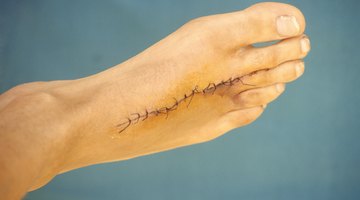 Cómo utilizar la cinta micropore en una cicatriz